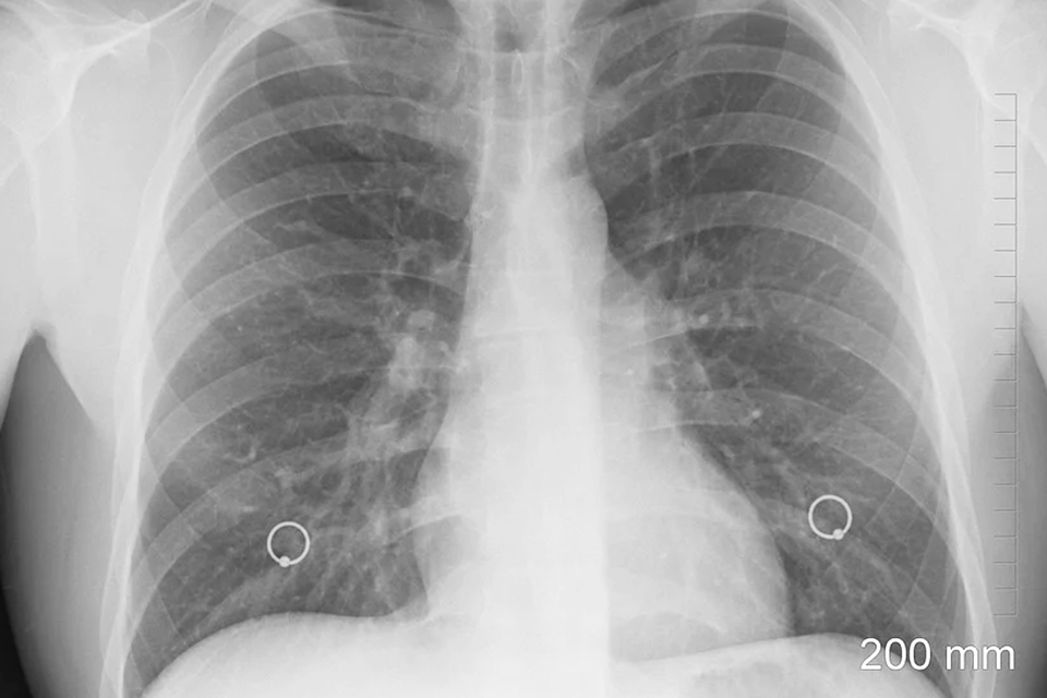 「肺癌」成台灣新國病女性罹患率呈年輕化趨勢 別忽視咳嗽、咳痰、胸痛等警訊以免錯失治療先機