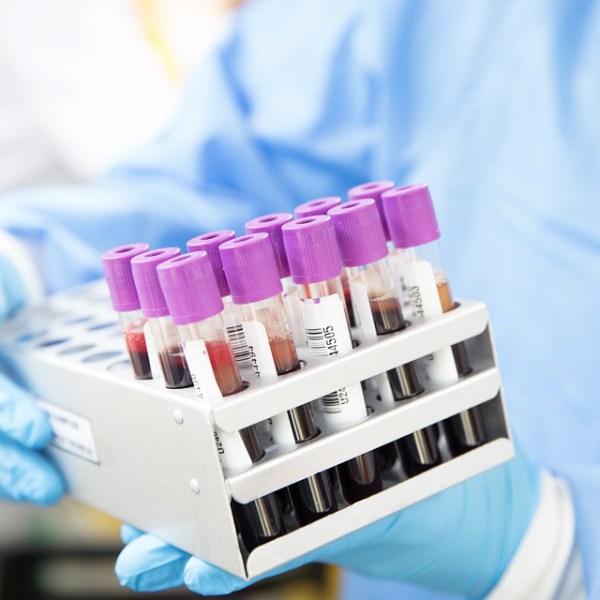 研究發現：早發性中風與決定血型的基因染色體之間 存在關聯性